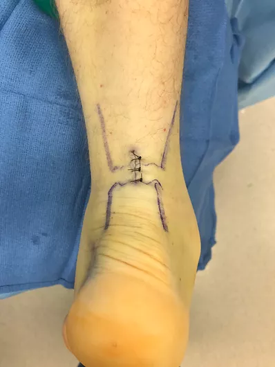 Ankle arthroscopy with debridement
