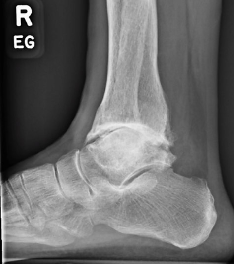 Ankle Arthritis Logo2