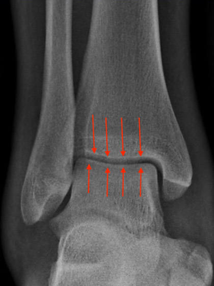 Ankle Arthritis3