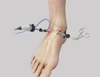 Ankle arthroscopy with debridement