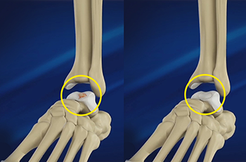 Ankle arthroscopy