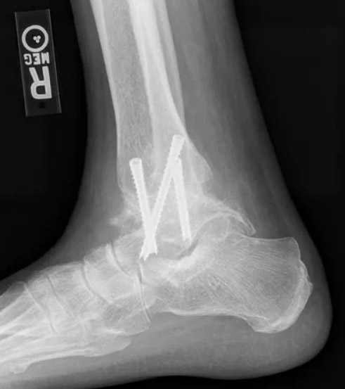 Ankle Arthritis5