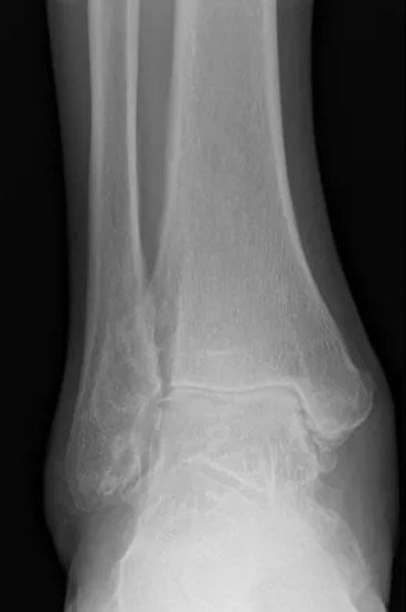 Ankle Arthritis image1