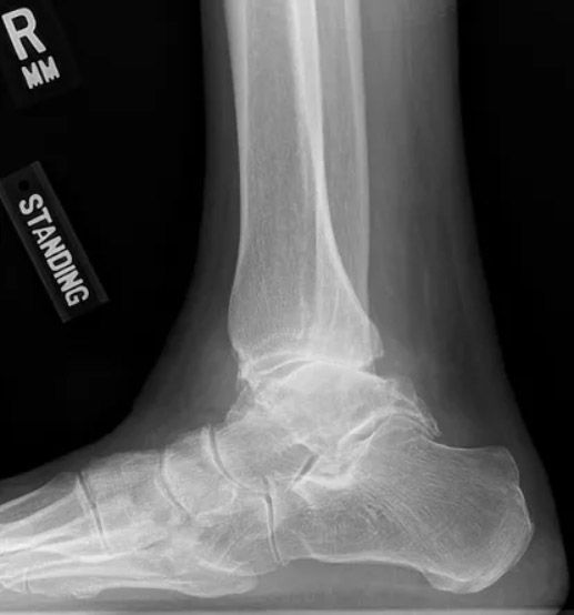 Ankle Arthritis Treatment Seattle, WA Ankle Specialist Seattle