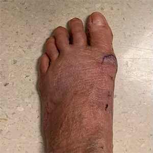 MIS Severe Deformity Correction2