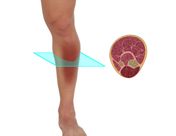 Exertional Compartment Syndrome