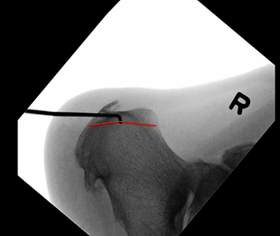 Ankle Arthritis Tendonitis