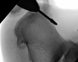 Ankle Arthritis1