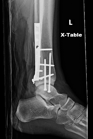 Foot & Ankle Fractures4