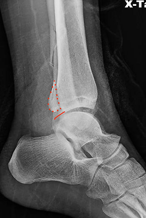 Foot & Ankle Fractures2