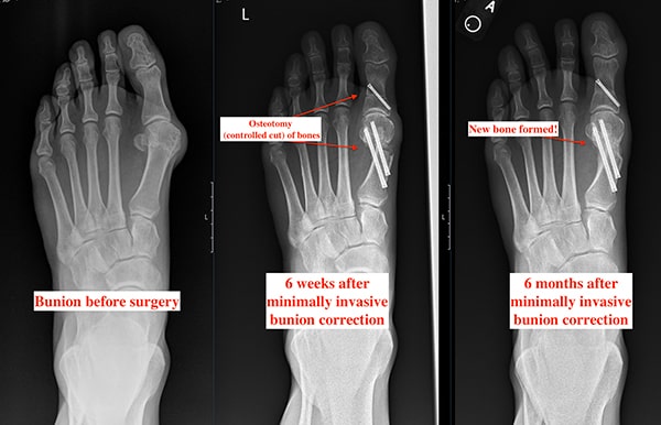 MIS bunion XR