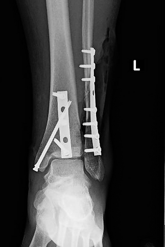 Foot & Ankle Fractures3