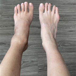 Anthony Yi, MD, Orthopedic Surgeon Specialist in Foot & Ankle Surgery