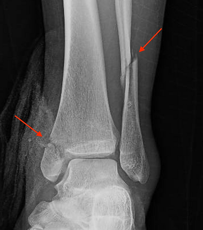 Foot & Ankle Fractures1