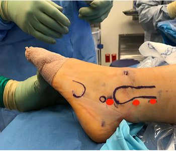 Exertional Compartment Syndrome