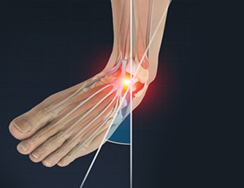 Ankle Sprains