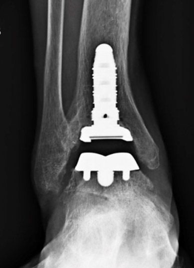 Ankle Arthritis img1