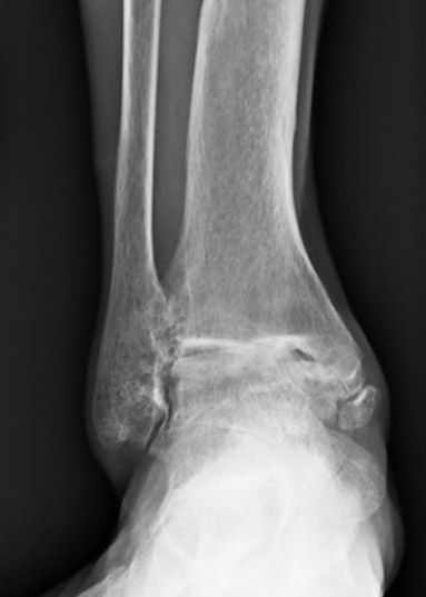 Ankle Arthritis pic1