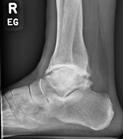 Ankle Arthritis pic2